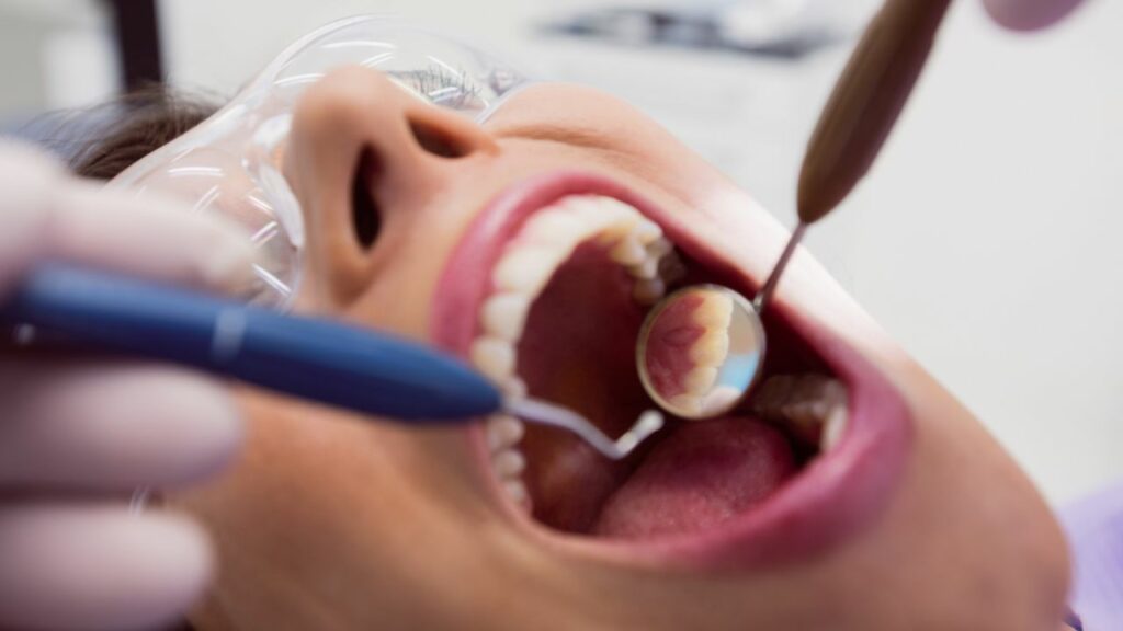Composite Fillings