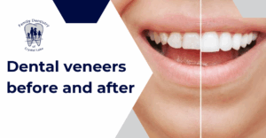 Close-up of a smile showing before and after results of dental veneers with visibly whiter, straighter teeth