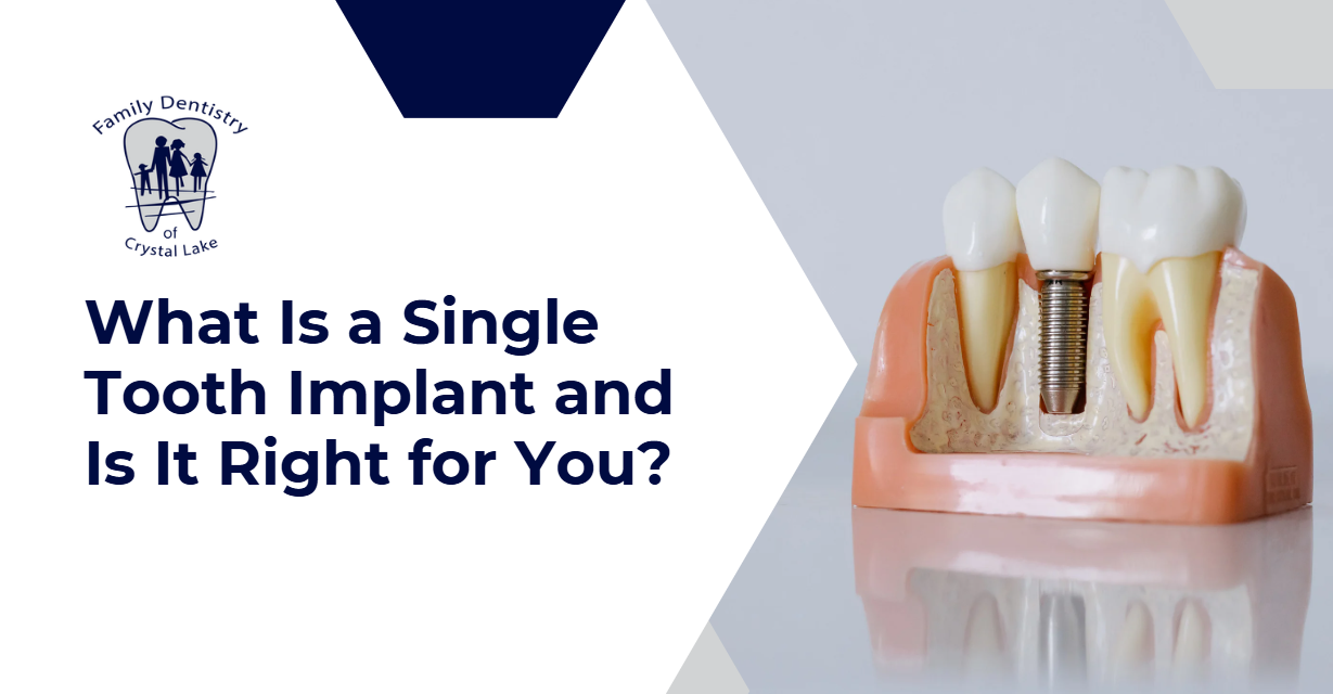Explore what a single tooth implant is and whether it's the right solution for your smile at Family Dentistry of Crystal Lake.