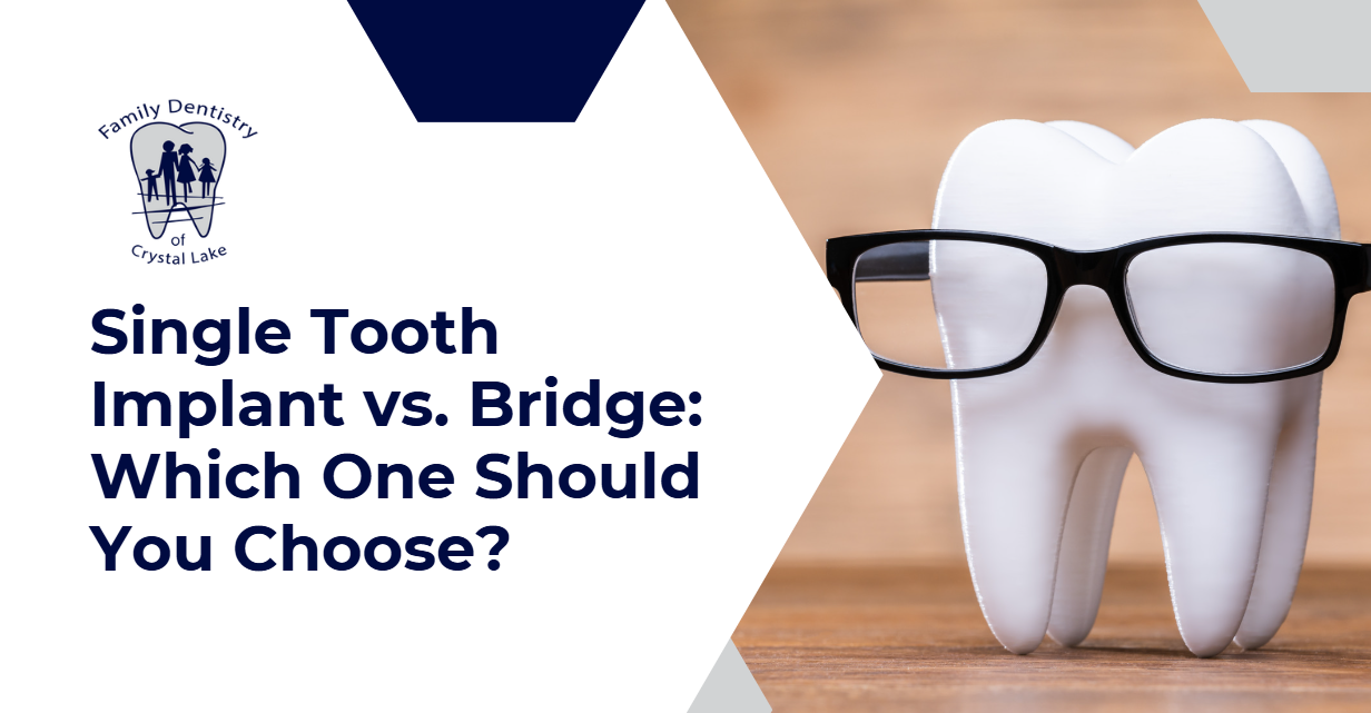 Tooth model wearing glasses next to the headline “Single Tooth Implant vs. Bridge: Which One Should You Choose?”—a visual cue for making smart dental decisions